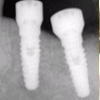 インプラント治療の人工歯根イメージ