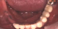 インプラント治療術前口腔内写真